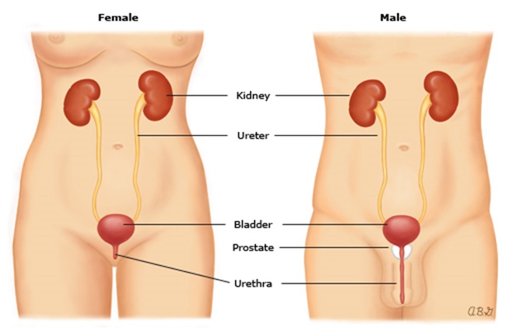 kidney stones